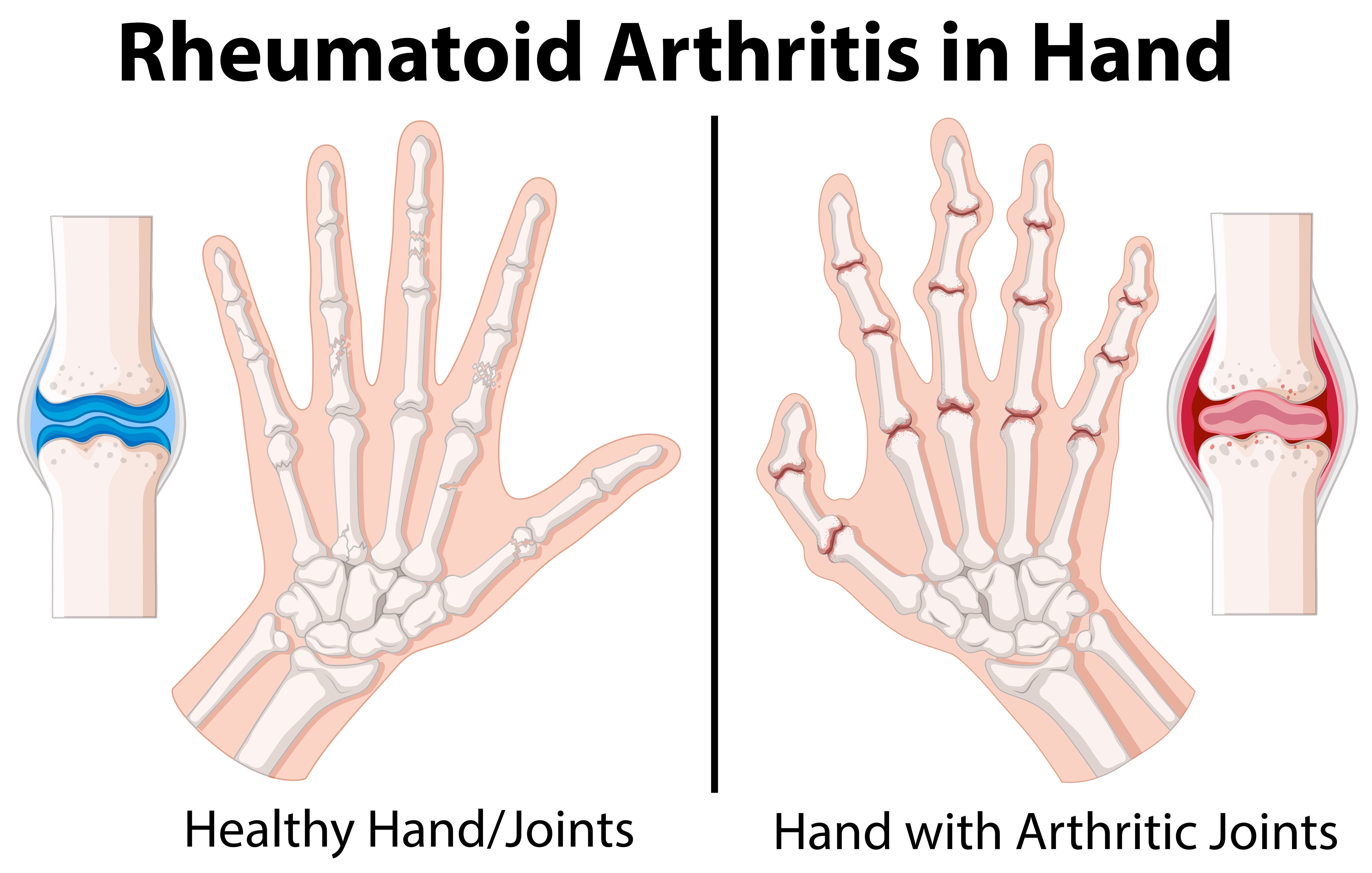 New Hope for Rheumatoid Arthritis